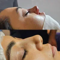 آف عمل جراحی بینی فقط۲۵ت دراهوازتااخرهفته