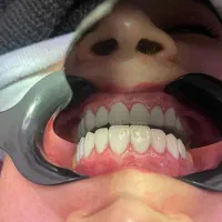 کامپوزیت دندان سارمکو - شرایط استثنائی و مدت محدود|خدمات زیبایی و سلامت|تهران, دروس|دیوار