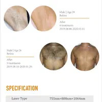 لیزر موهای زائد با دستگاه آلمانی 20%تخفیف|خدمات آرایشگری و زیبایی|سیرجان, |دیوار