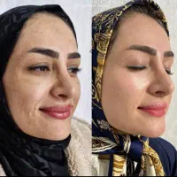 رفع لک تحصصی با کوکتل مخصوص/توسط پزشک