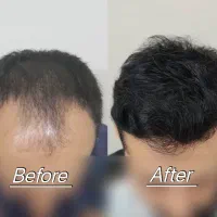 جشنواره همدلی  ۵۰ درصد تخفیف کاشت مو شیراز