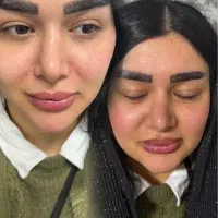 تزریق ژل و بوتاکس499
