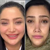 جوانسازی با ژل وفیلر به سبک بالانس فیس و گلو لیفت