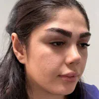 کاشت ابرو با قیمت باورنکردنی