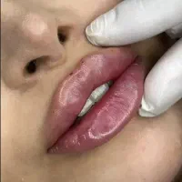 تزرق بوتاکس ژل لب گونه چونه زاویه در کلینیک