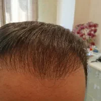 موهای پرپشت دیگر رویا نیست با فولیکول تراپی