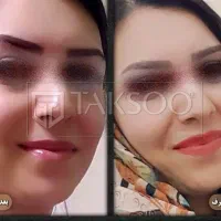 چاقی صورت در چند هفته