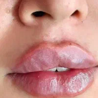 تزریق ژل و بوتاکس|خدمات آرایشگری و زیبایی|هشتگرد, شهرک ولیعصر (مصلی)|دیوار