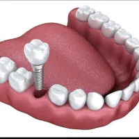ایمپلنت دیجیتال کرمان