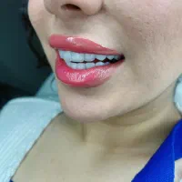 کامپوزیت دندان لیرینگ لب شیشه