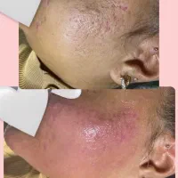 مدل رایگان برای پوست جوش دار و اسکار و لک|خدمات آرایشگری و زیبایی|رشت, گلباغ نماز|دیوار