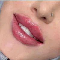 مدل ژل و بوتاکس