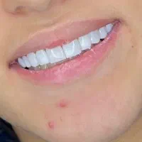 کاموزیت و زیبایی دندان