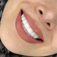کامپوزیت روکش عصب کشی
