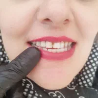 دندان خرابت رو جایگزین کن