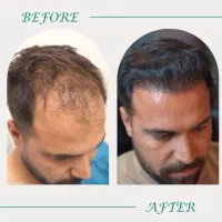 کاشت مو با جدیدترین روش