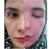 انجام لیزرco2و فرکشنال