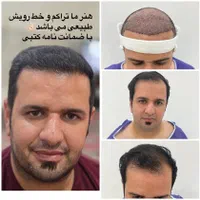 کاشت مو،ابرو و ریش توسط بنیان‌گذار کاشت موی ایران