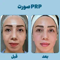 پی آر پی(جوانسازدرمان لک جوش قطع ریزش)مطب پزشک499|خدمات زیبایی و سلامت|اصفهان, ملکشهر|دیوار
