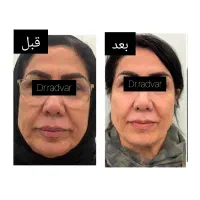 اندولیفت صورت و بدن با دستگاه یوفوتون ایتالیا|خدمات آرایشگری و زیبایی|کرج, شهرک مترو|دیوار