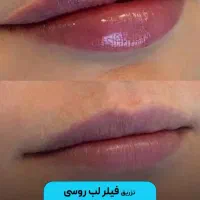 خدمات زیبایی تزریق فیلر ،بوتاکس و لیزر در مطب پزشک|خدمات آرایشگری و زیبایی|قم, نیروگاه|دیوار