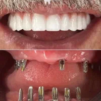 مرکز تخصصی دندانپزشکی ایمپلنت آلمانی(اقساط ۱۲ماهه)|خدمات آرایشگری و زیبایی|تبریز, |دیوار