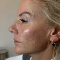 پاک کردن تتو با لیرز در مطب