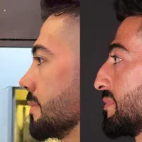 جراحی تیپ‌پلاستی بینی بصورت اقساط۱۸ ماهه|خدمات آرایشگری و زیبایی|خرم‌آباد, |دیوار