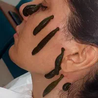 حجامت بادکش امبدینگ طب سوزنی زگیل تناسلی hpv|خدمات آرایشگری و زیبایی|اصفهان, جاوان|دیوار