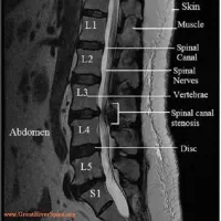 درمان کمر درد دیسک|پزشکی|ساوه, |دیوار