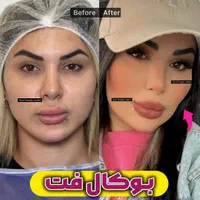 بلفاروپلاستی-سانترال لب-بوکال فت-ساکشن غبغب|خدمات آرایشگری و زیبایی|تهران, پاسداران|دیوار