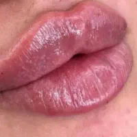 ژل بوتاکس مزو انزیم .پرسینگ .لیفت نخ .چال لپ|خدمات آرایشگری و زیبایی|شاهینشهر, شهرک پردیس|دیوار