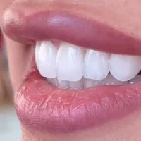 کامپوزیت دندان روکش دندانپزشک تهرانسر اکباتان خلیج|خدمات آرایشگری و زیبایی|تهران, تهرانسر شمالی|دیوار