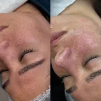 جوانسازی پوست با پی ارپی ،اگزوزوم ،مزوژل و.|خدمات آرایشگری و زیبایی|مشهد, مقدم|دیوار