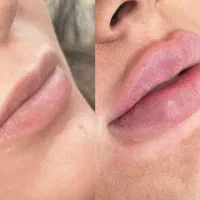 ژل و بوتاکس فیلر مزو ژل مزو تخفیف ویژه فول فیس|خدمات آرایشگری و زیبایی|مشهد, ملک‌آباد|دیوار