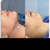 لیپو ابدو کاشت مو ابرو تزریق چربی ژل بوتاکس بلفارو|خدمات آرایشگری و زیبایی|اهواز, نادری|دیوار