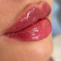 ژل مزو بوتاکس فیلر اقساط توسط پزشک با ۴۰٪ تخفیف