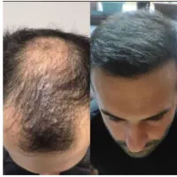 آخرین راه پرپشتی موهات اینجاست