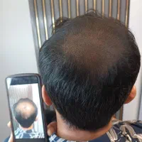 میکرواسکالپ سر ،اسکالپ سر ، پرپشتی مو در مطب پزشک|خدمات آرایشگری و زیبایی|اهواز, کیانپارس |دیوار
