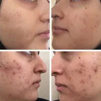 آموزش خدمات پی آرپی،مزوتراپی،بلکسر،فیشال،اسید|خدمات آرایشگری و زیبایی|کرج, گوهردشت|دیوار