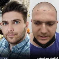 کاشت مو و ابرو/بلفاروپلاستی/عمل بینی/غبغب/تزریق ژل