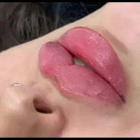 تخفیف ژل ،بوتاکس ،جوانساز،فیلر وفیشیال