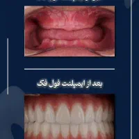 ایمپلنت فقط با پیش پرداخت 88۰۰