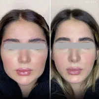 تخفیف ژل و بوتاکس و مزوتراپی و تزریق چربی|خدمات آرایشگری و زیبایی|صدرا-فارس, فاز ۱|دیوار