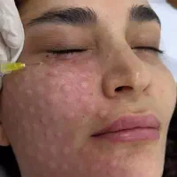 تخفیف ویژه بوتاکس، ژل، پی آر پی، رفع کک و مک|خدمات آرایشگری و زیبایی|بوکان, |دیوار