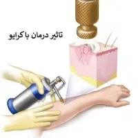 درمان و ریمو زگیل تناسلی