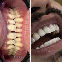 کامپوزیت‌ولمینت زیبایی ۵۰ درصد تخفیف