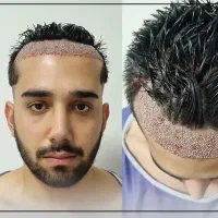 میکروکاشت ابرو و مو فقط 16.800 ظرفیت محدود|خدمات زیبایی و سلامت|قم, زنبیل آباد|دیوار