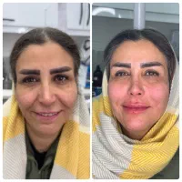 جشنواره لیفت تخصصی صورت با نخ و کانتورینگ|خدمات آرایشگری و زیبایی|بروجرد, |دیوار