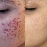 جوش های صورتتو با این کرم خفن برای همیشه بردار